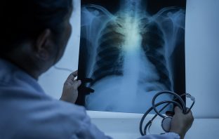 Lung Cancer: New Report Reveals New York Among Best in Nation for Early Diagnosis, Surgery, and Survival
